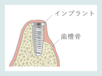 骨誘導再生法（GBR）インプラント埋入