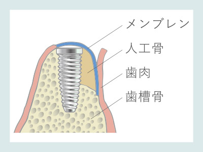 骨誘導再生法（GBR）人工骨を埋入