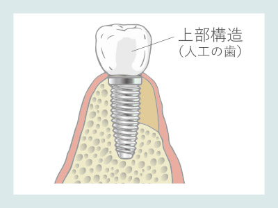 骨誘導再生法（GBR）人工歯装着