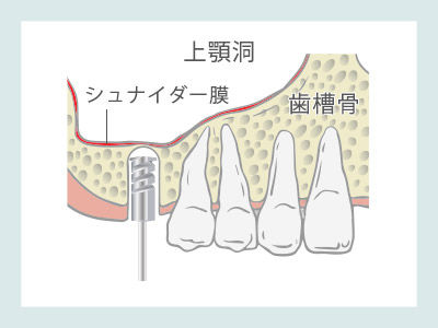 ソケットリフト　歯肉を切開