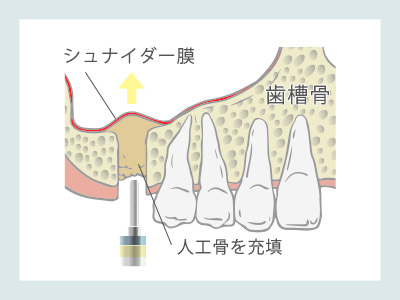 ソケットリフト　人工骨を充填