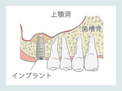 ソケットリフト　インプラント埋入