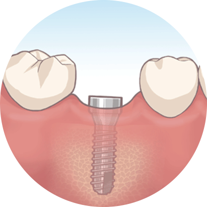 インプラント埋入