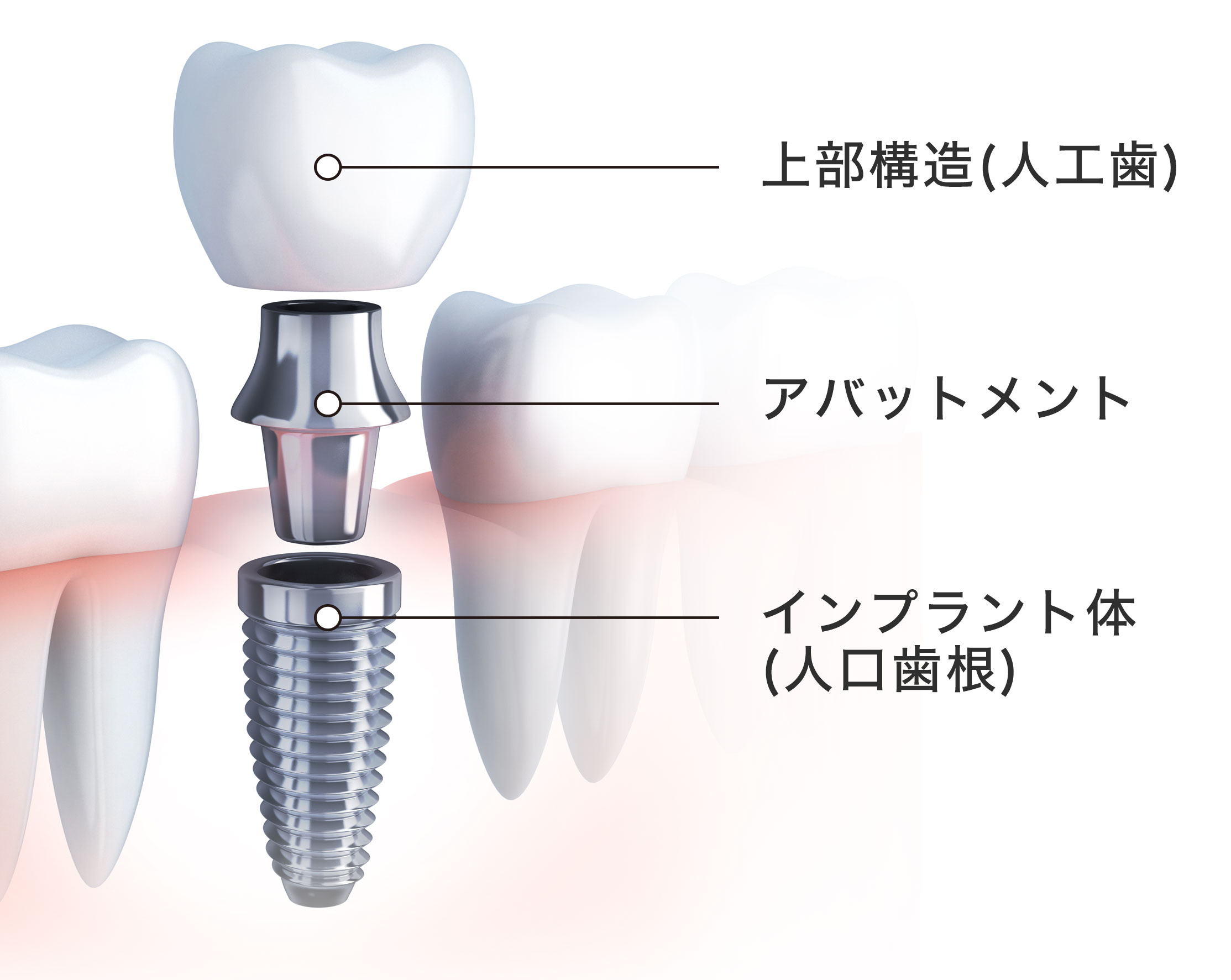 インプラント の 構造