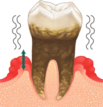 進行した歯周病
